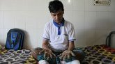 Bangladesh : la cruelle rechute de "l'homme-arbre" déclaré guéri